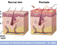 Skins Psoriasis and Cardiovascular Disease Risk