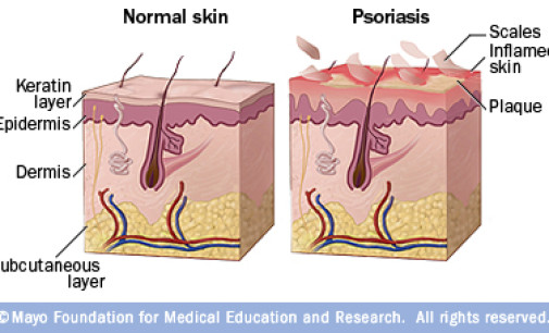 Skins Psoriasis and Cardiovascular Disease Risk
